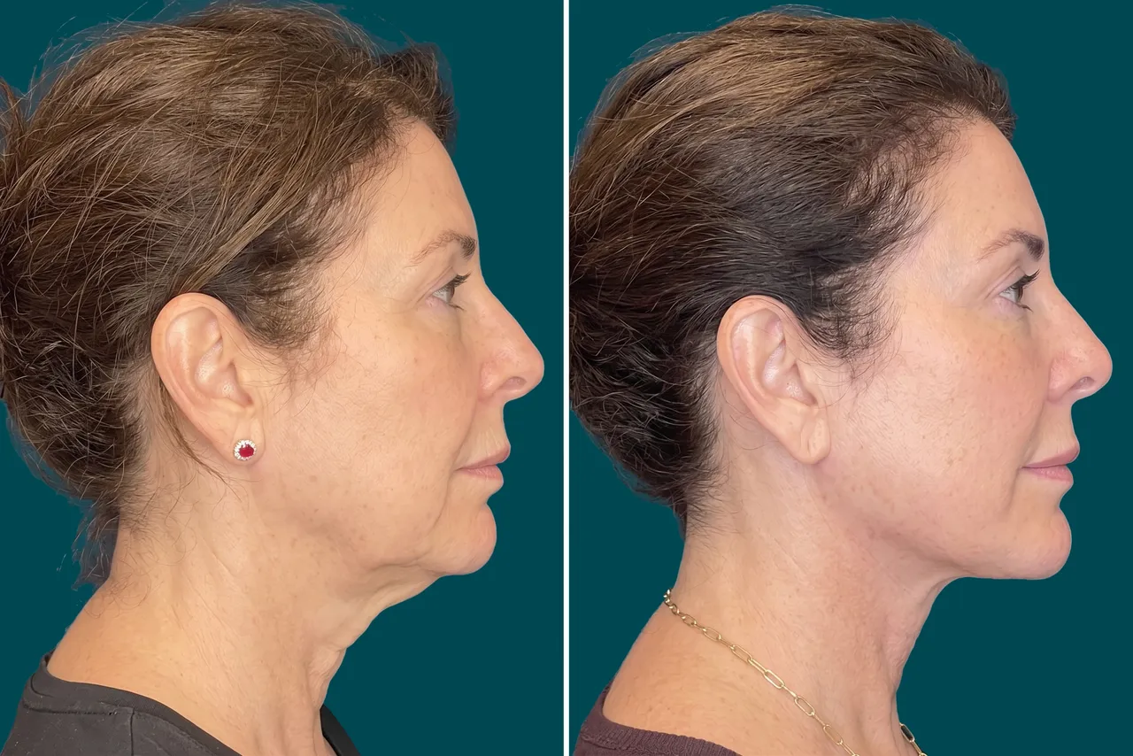 Neck Lift Before and After 3