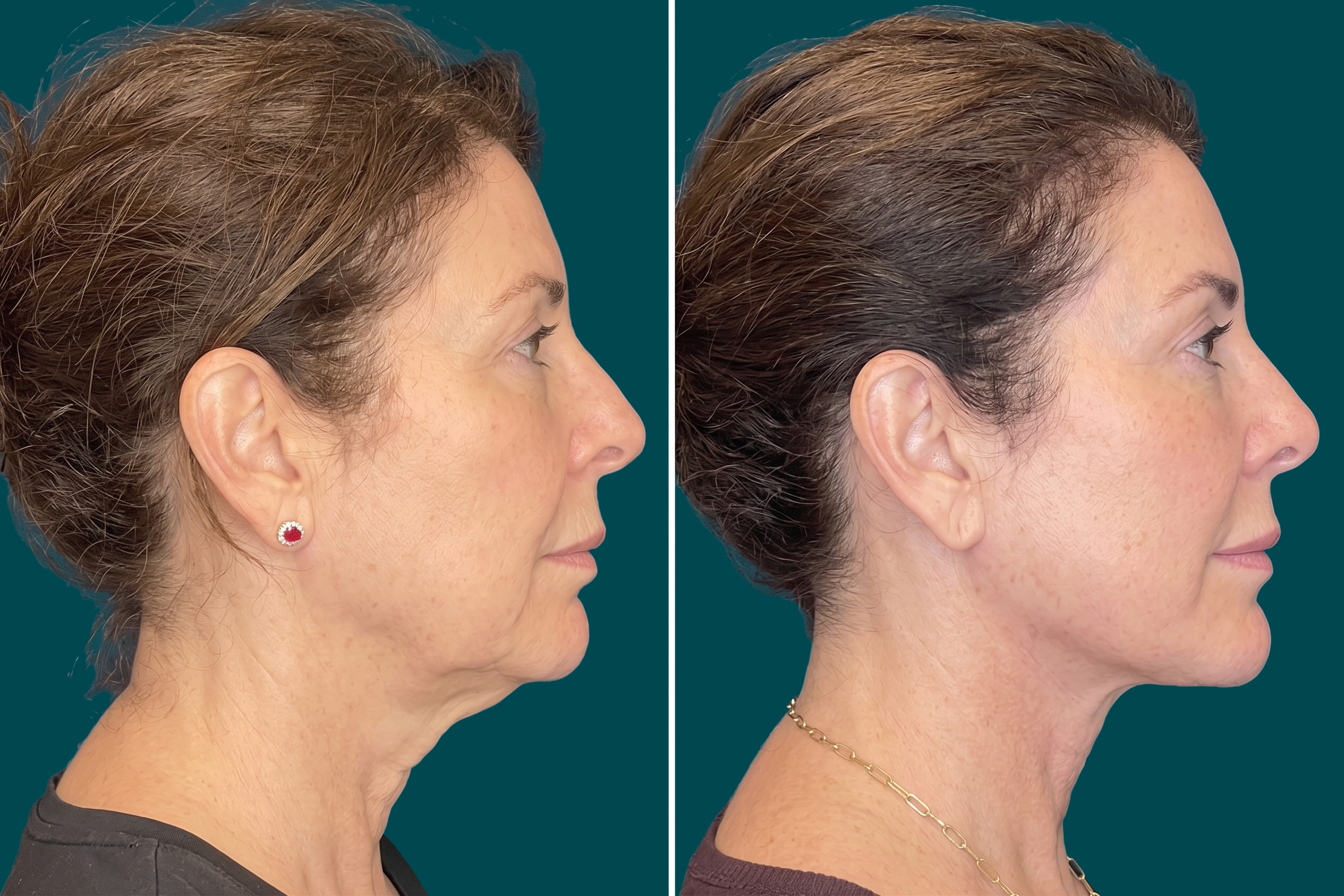 Neck Lift Before and After 3