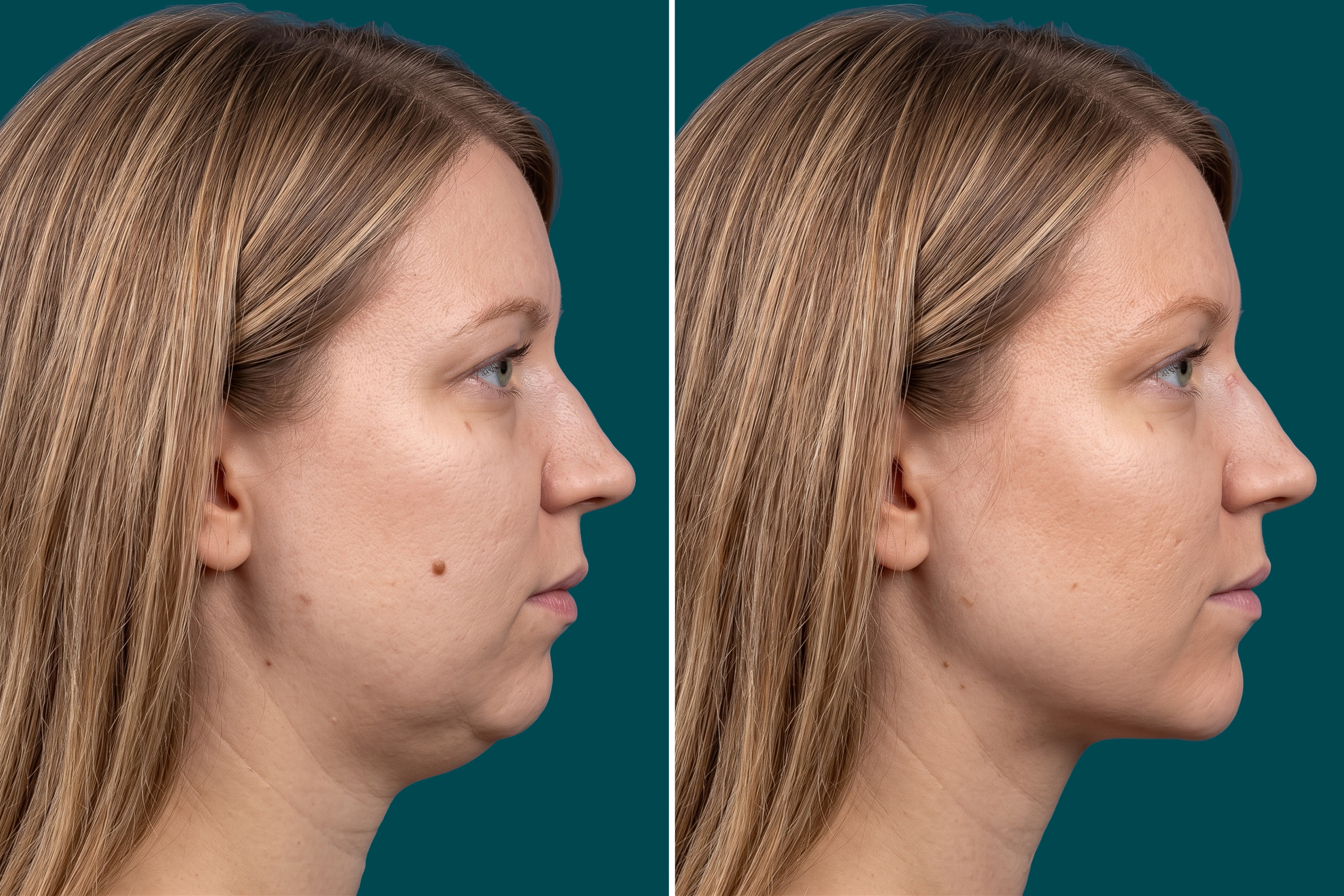 Neck Lift Before and After 5