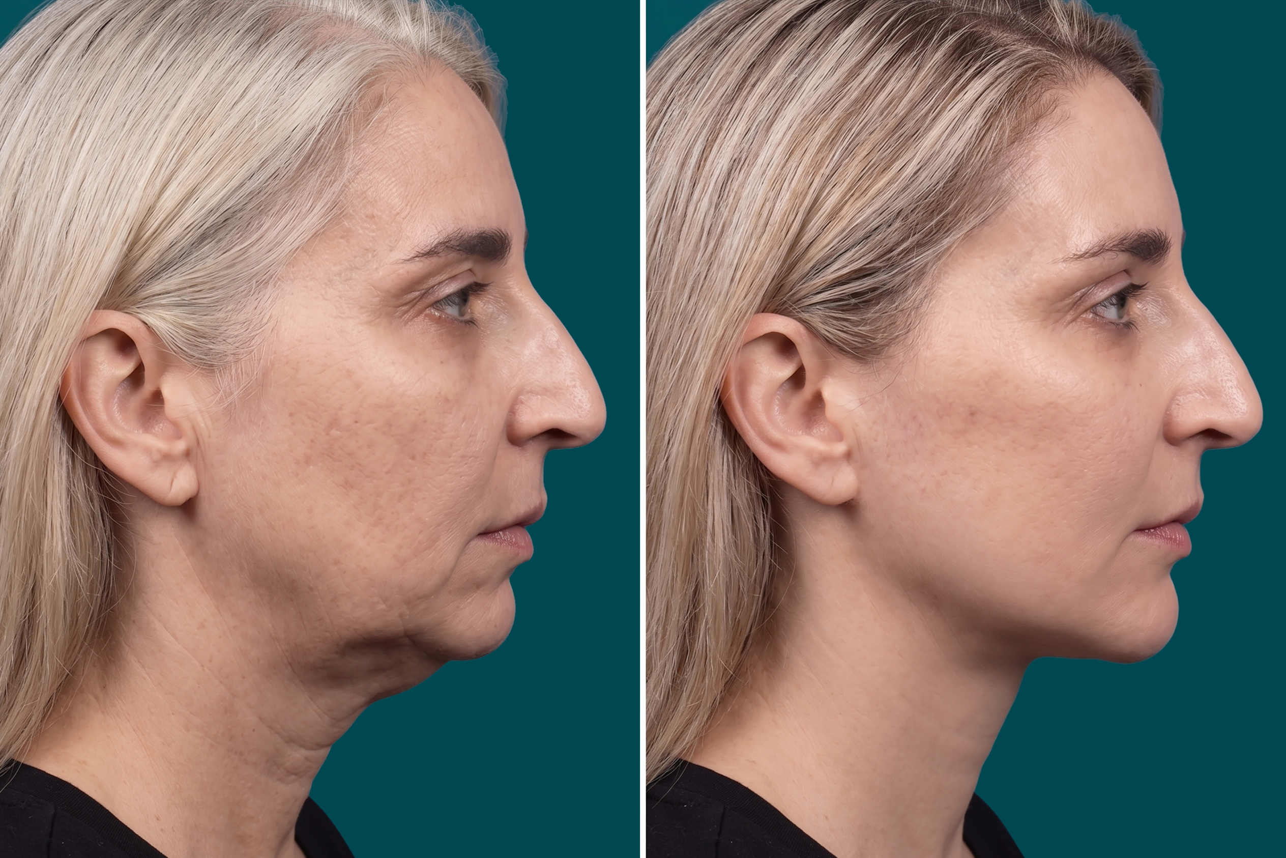 Neck Lift Before and After 6