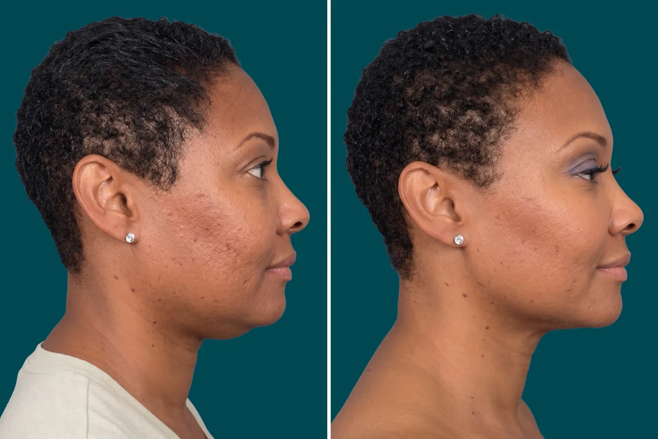Neck Lift Before and After 7
