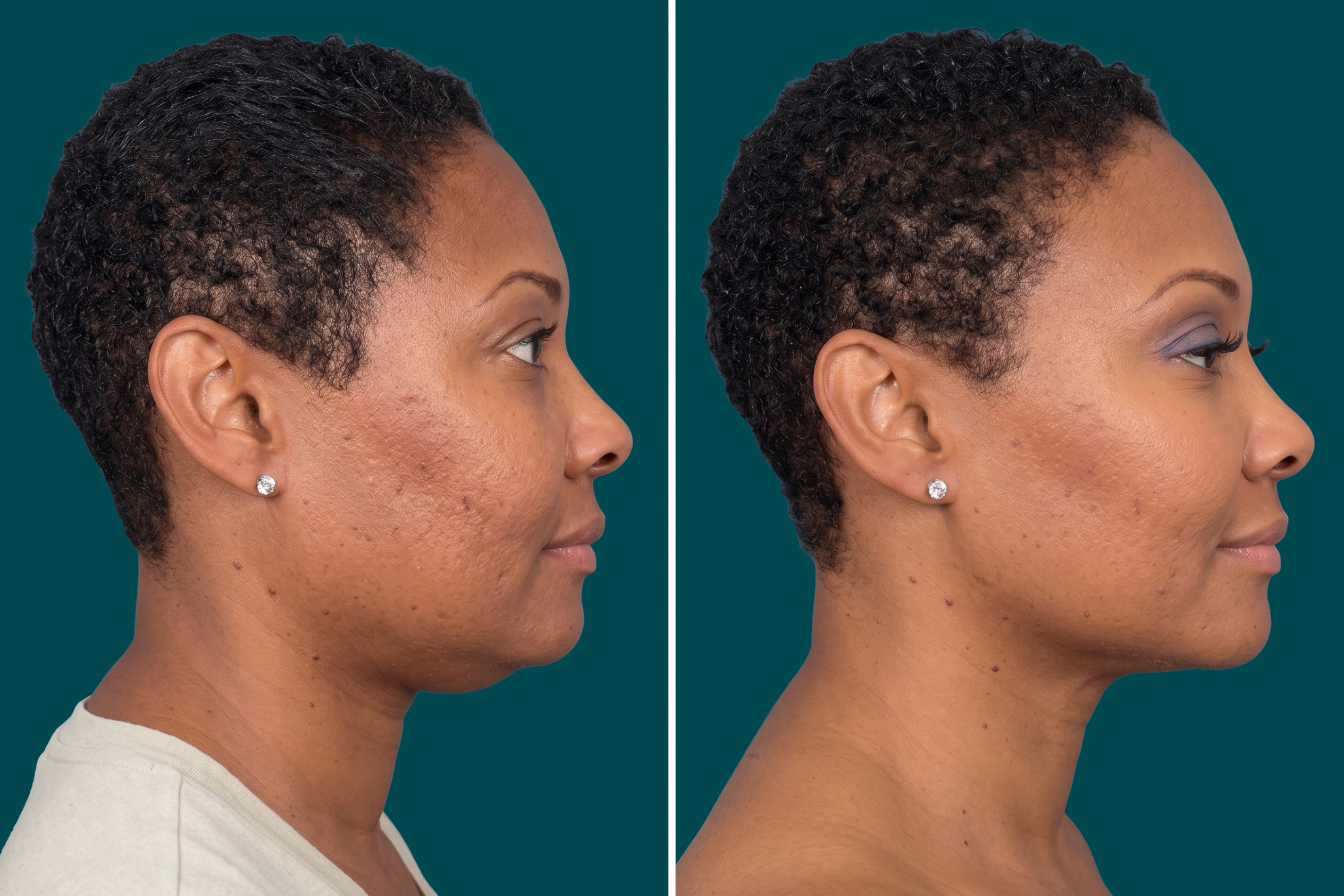 Neck Lift Before and After 7