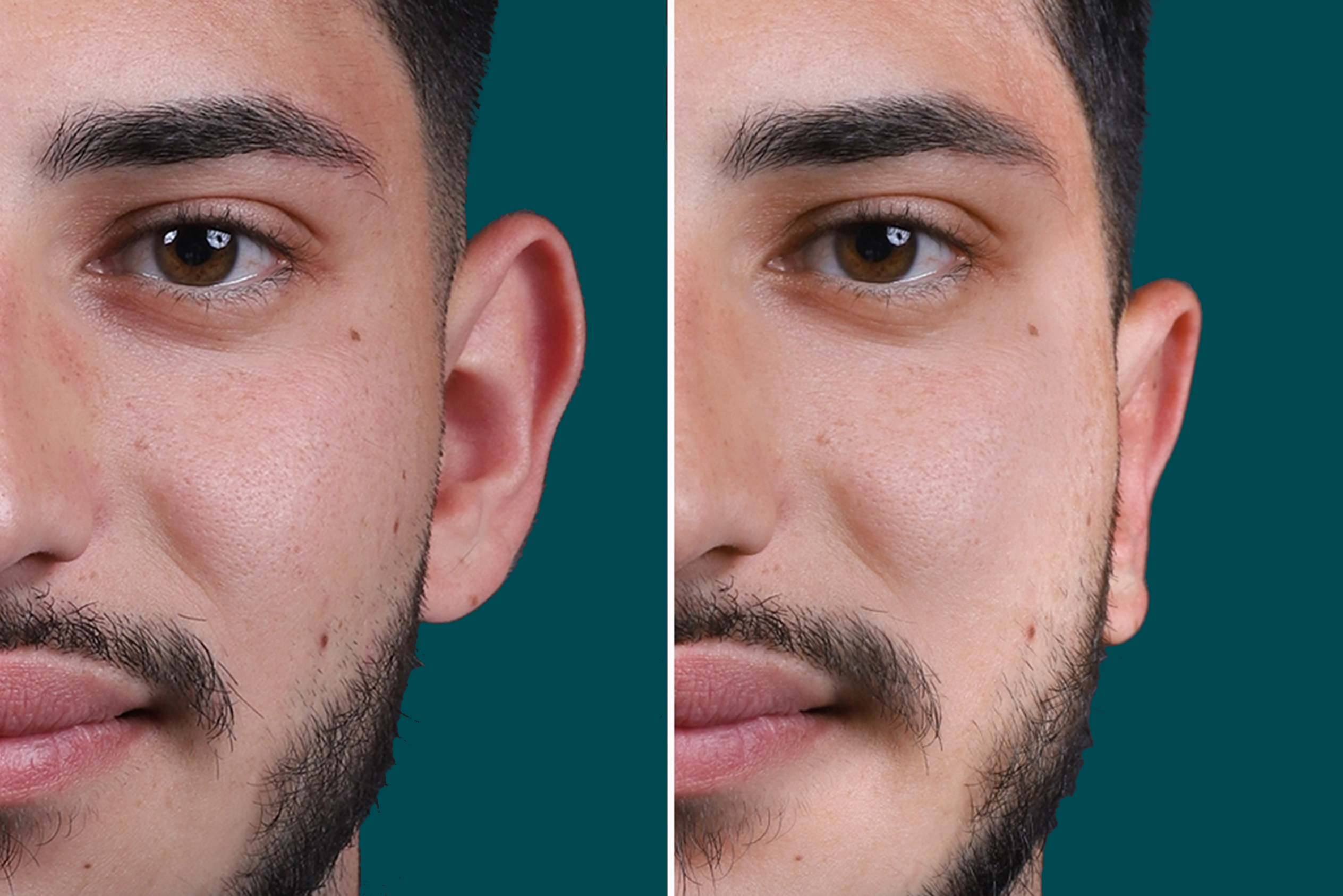 Otoplasty Before and After 1