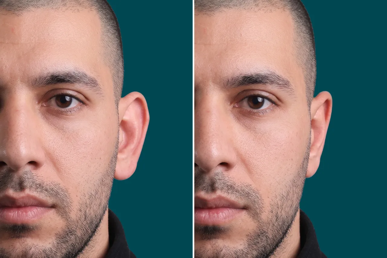 Otoplasty Before and After 3