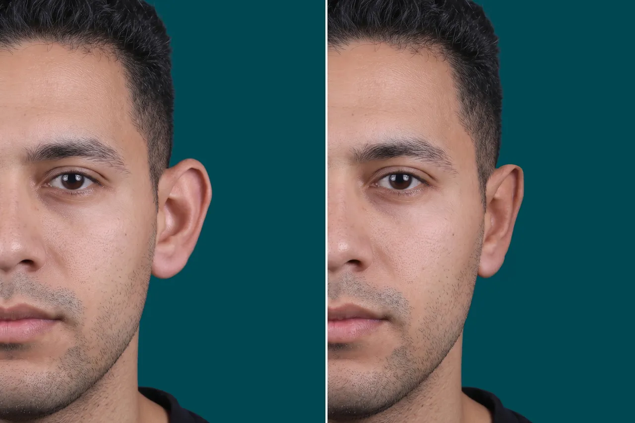 Otoplasty Before and After 4