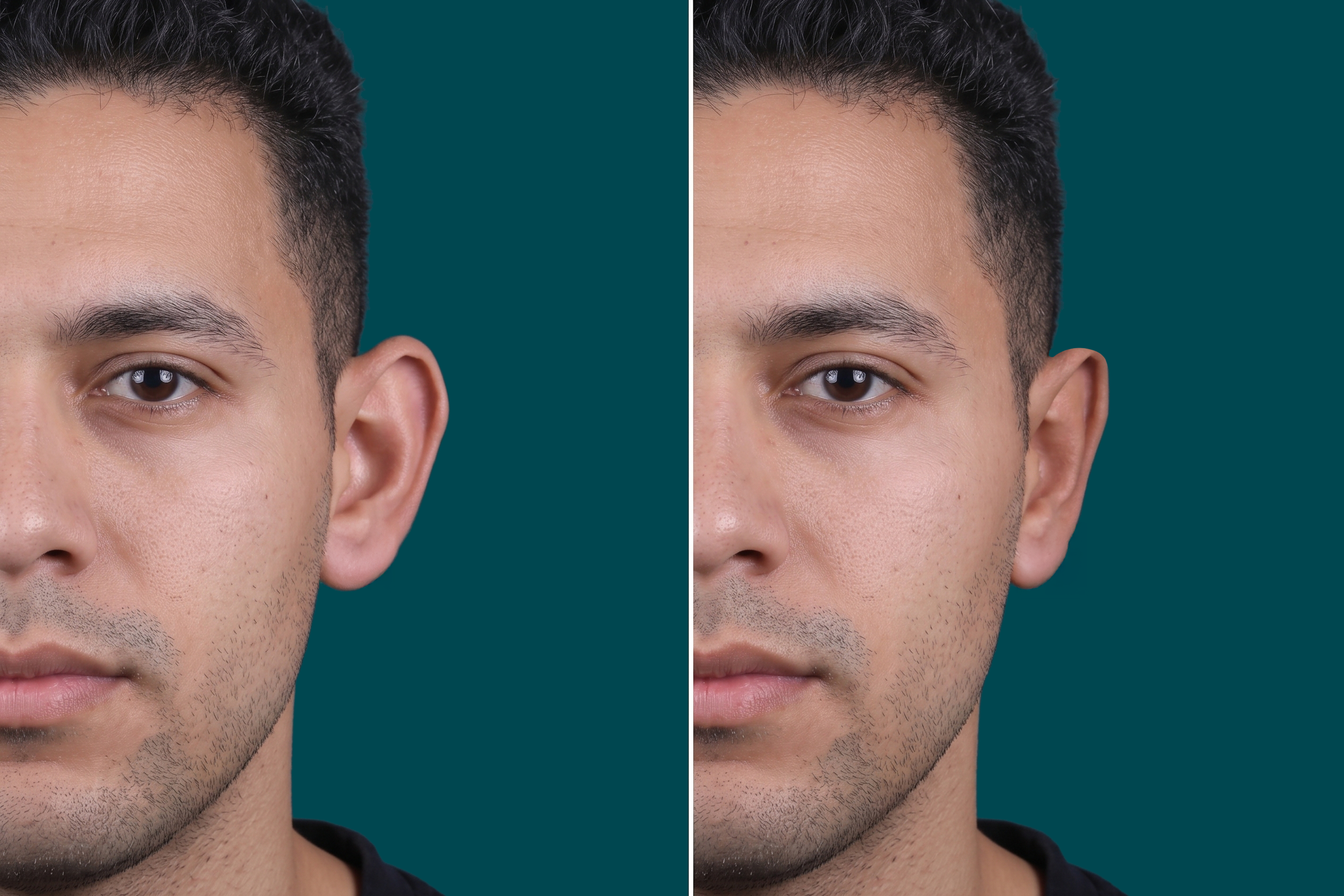 Otoplasty Before and After 4