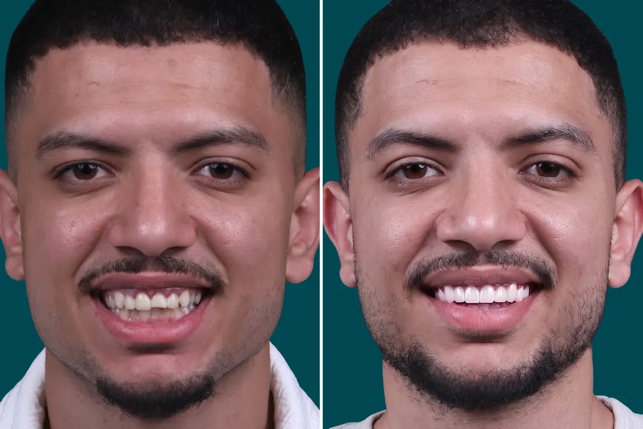 Dental-Crowns-Porcelain Crowns 2