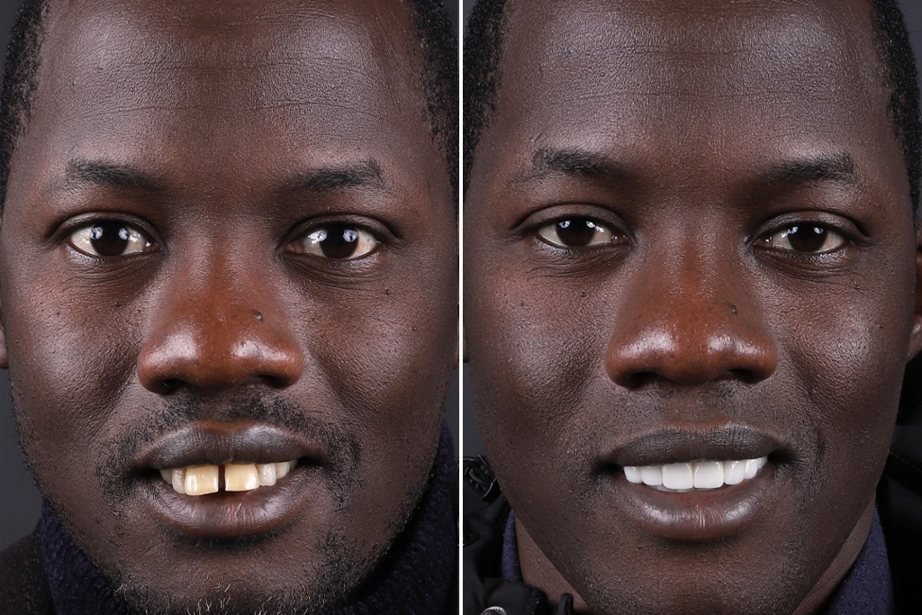 Before treatment