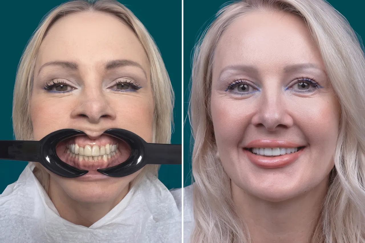 Dental Veneers-Porcelain Veneers 5