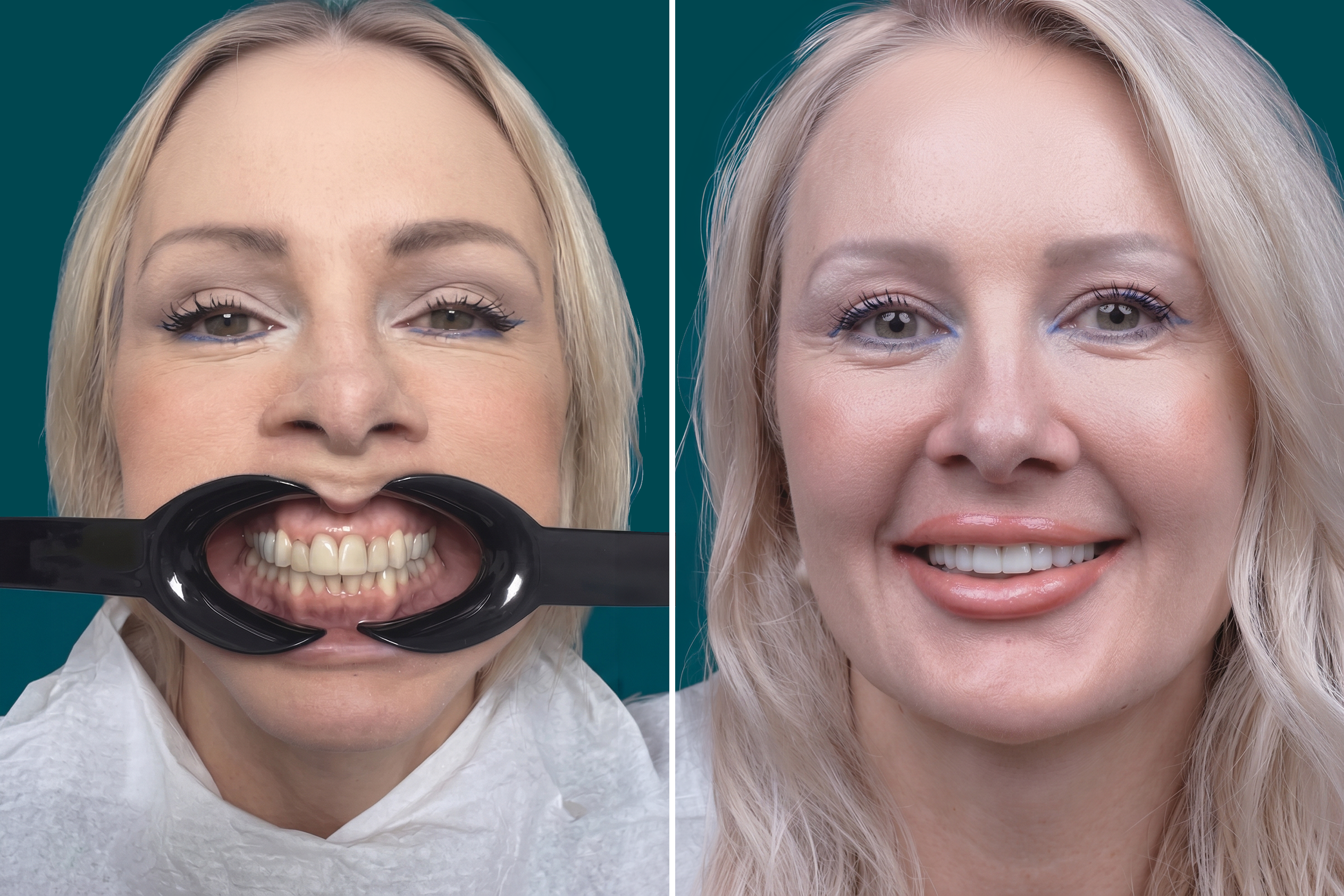 Dental Veneers-Porcelain Veneers 5