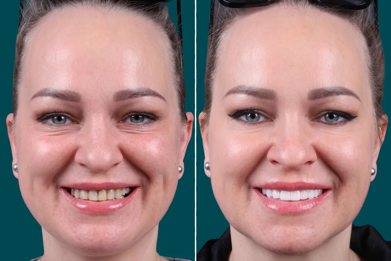 Dental Veneers-Porcelain Veneers 2