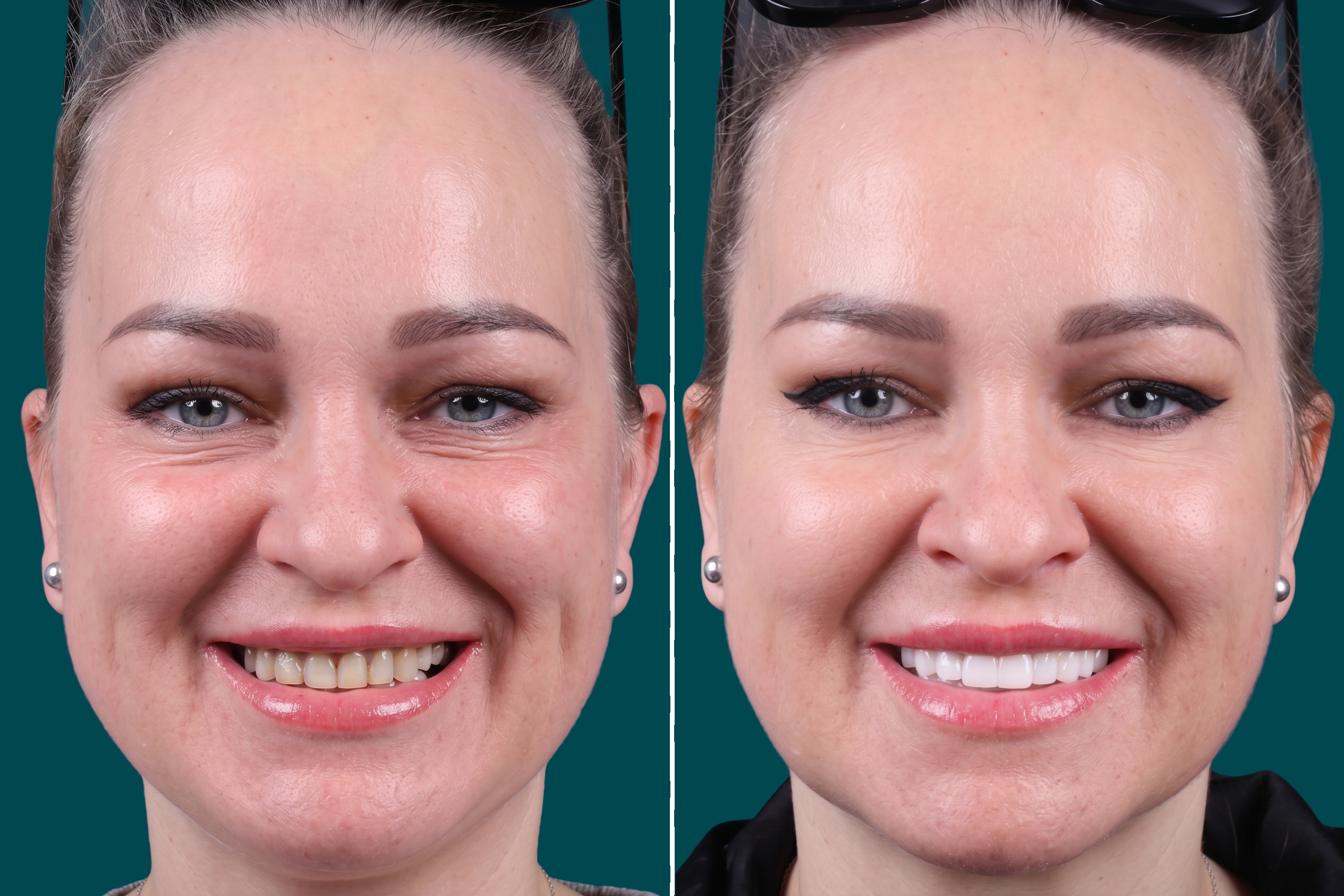Dental Veneers-Porcelain Veneers 2