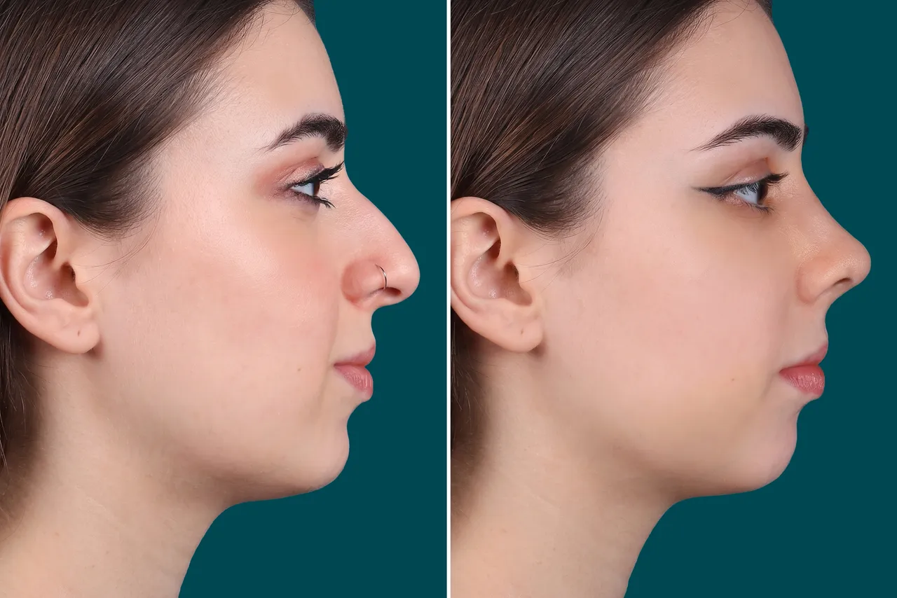 Rhinoplasty Before and After 2