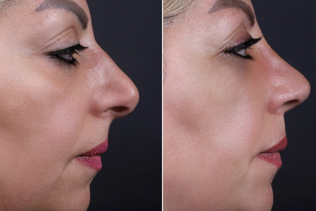 Rhinoplasty Before After In Turkey 11 (1)