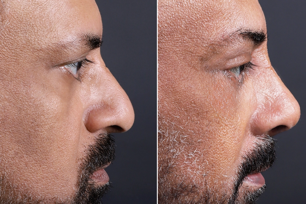 Rhinoplasty Before After In Turkey 12 (1)