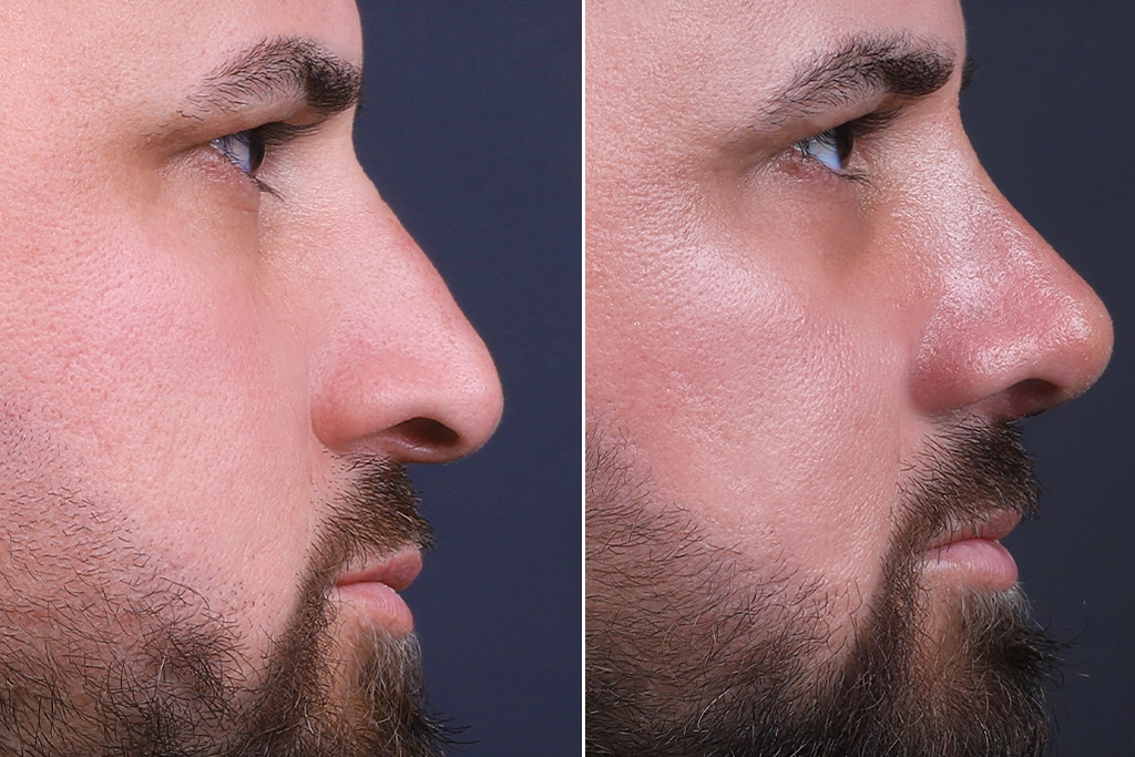 Rhinoplasty Before After In Turkey 13 (1)