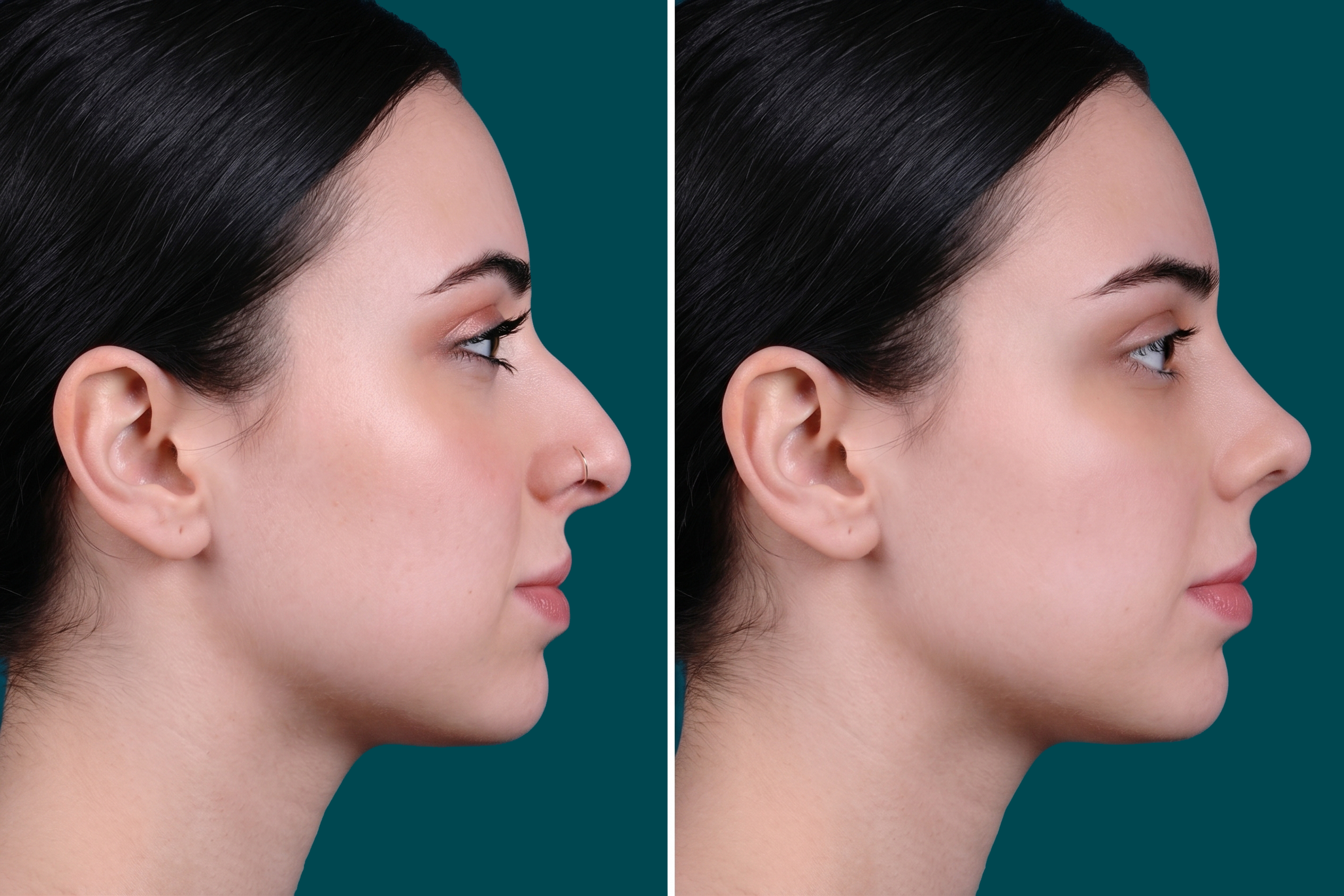 Rhinoplasty Before and After 13