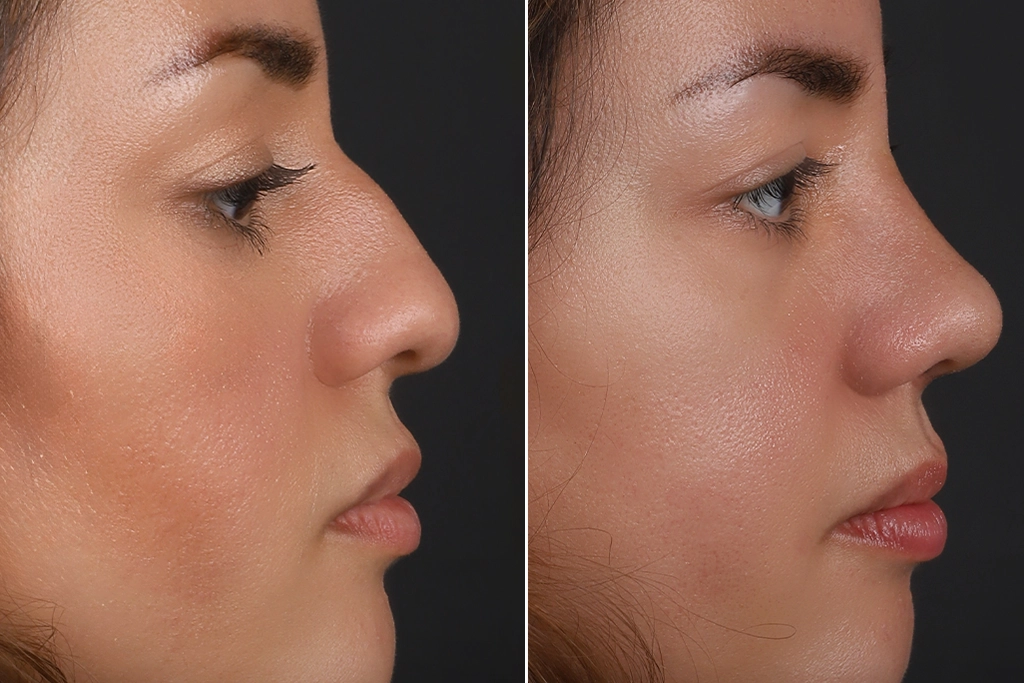 Rhinoplasty Before After In Turkey 14 (1)