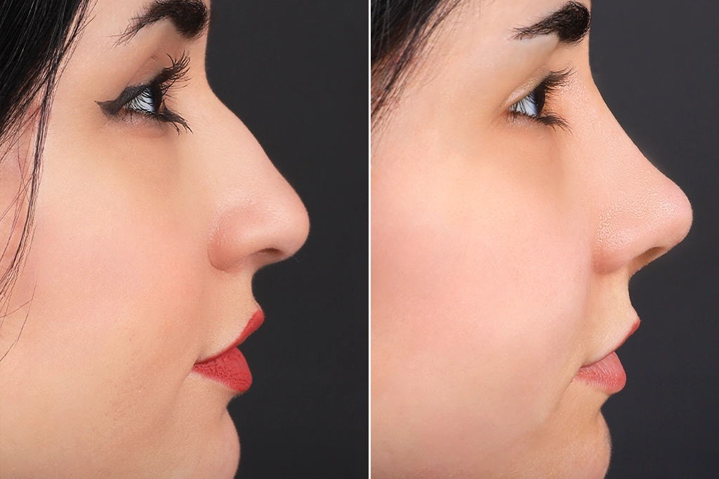 Rhinoplasty Before After In Turkey 15 (2)