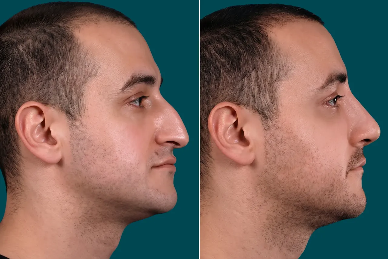 Rhinoplasty Before and After 4