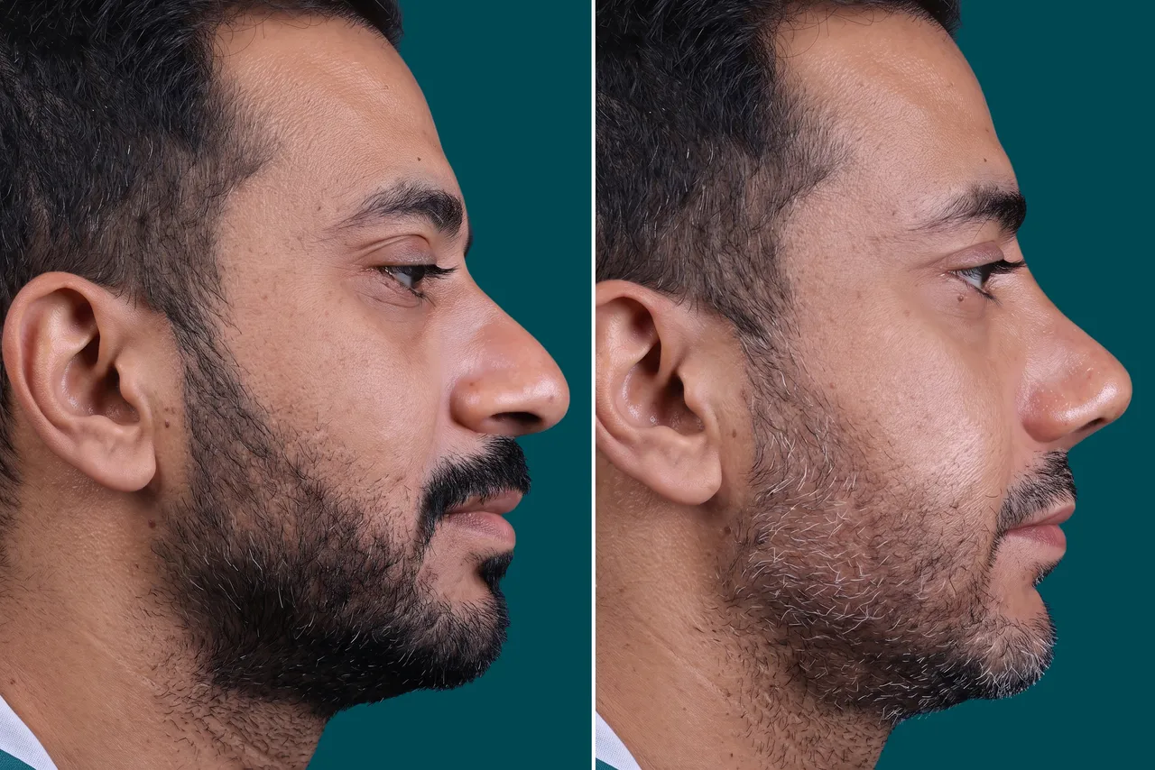 Rhinoplasty Before and After 5