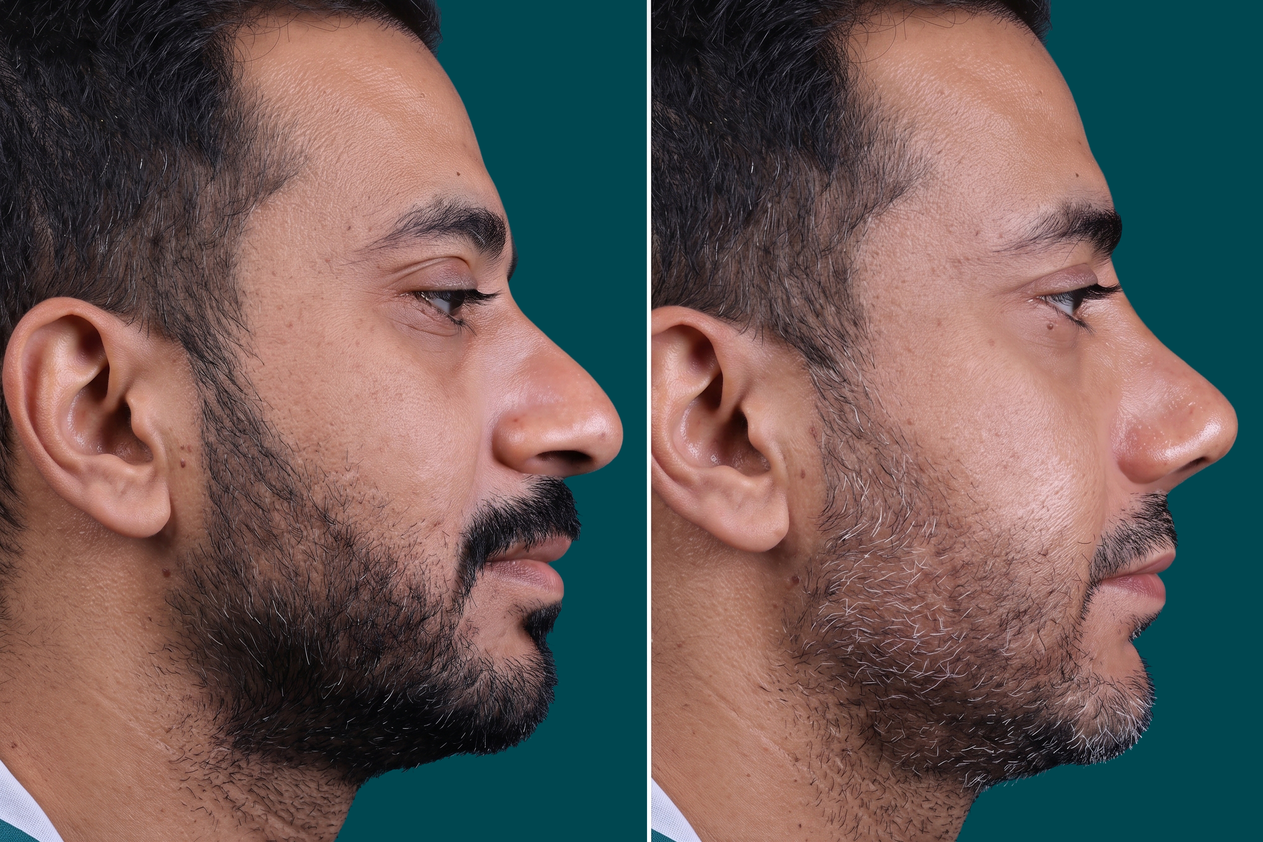Rhinoplasty Before and After 5