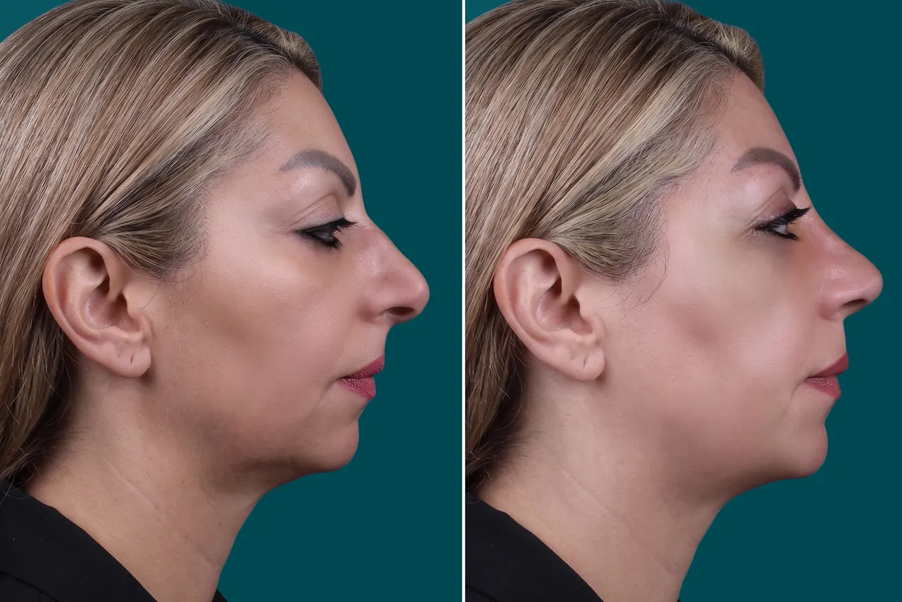 Rhinoplasty Before and After 6