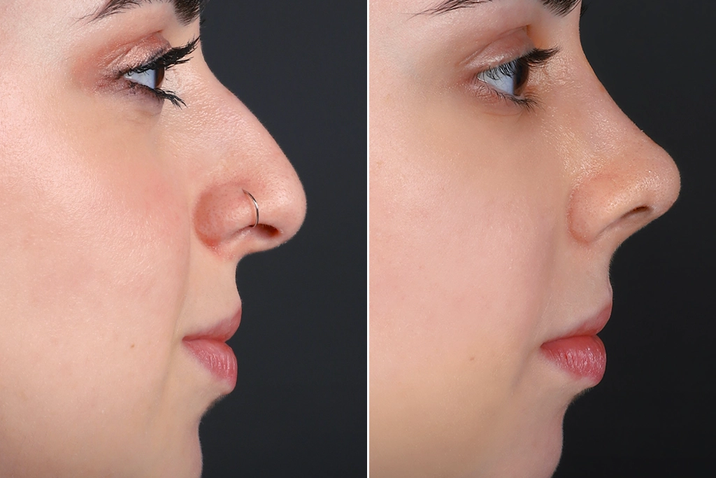 Rhinoplasty Before After In Turkey 8 (1)