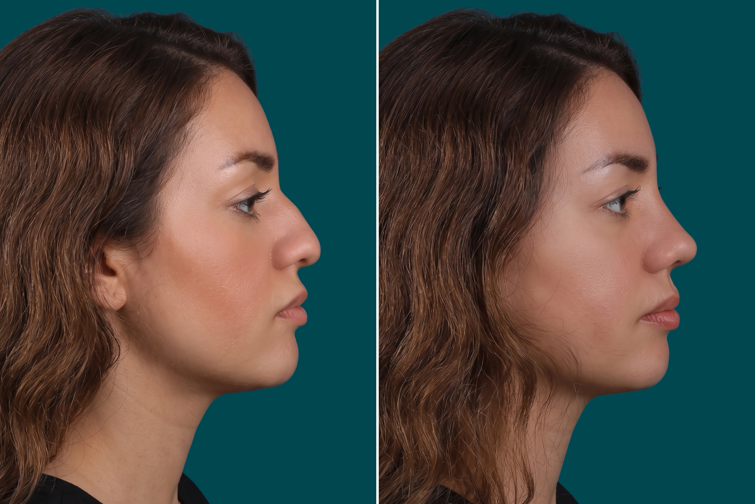 Rhinoplasty Before and After 8