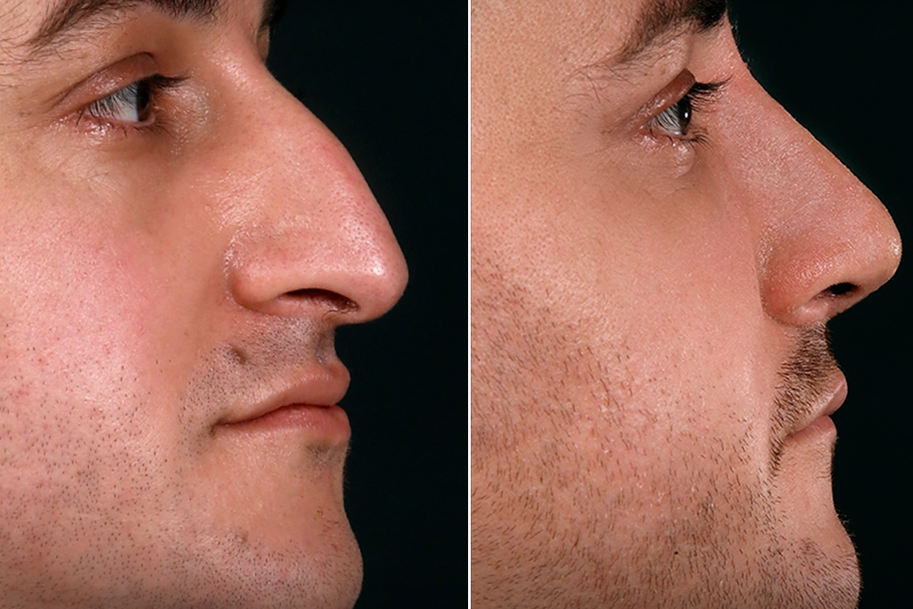 Rhinoplasty Before After In Turkey 9 (2)