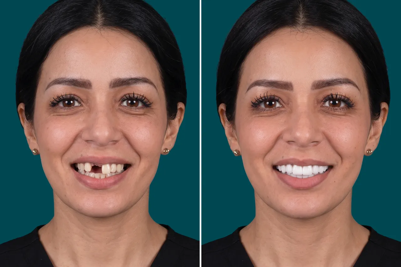 Dental Implants-Single Dental Implant 1