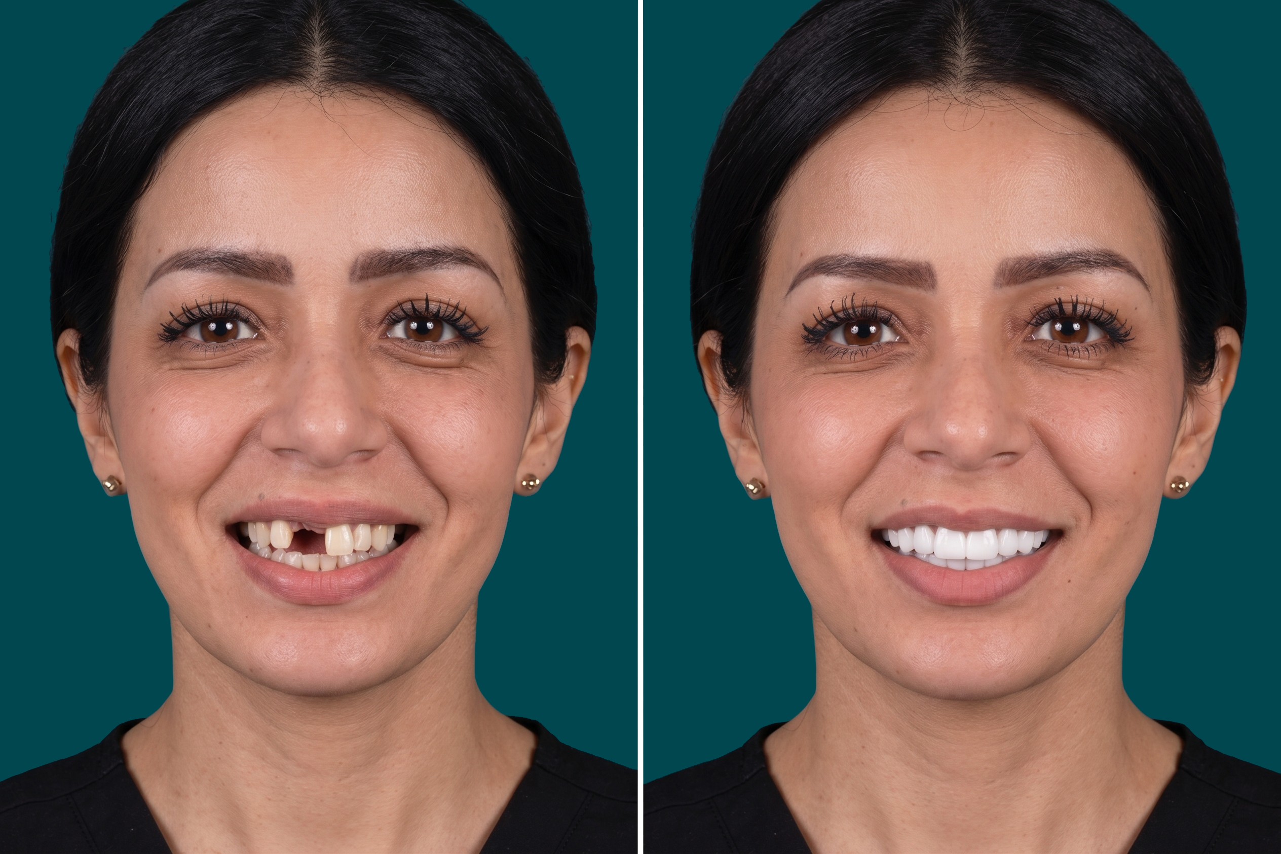 Dental Implants-Single Dental Implant 1
