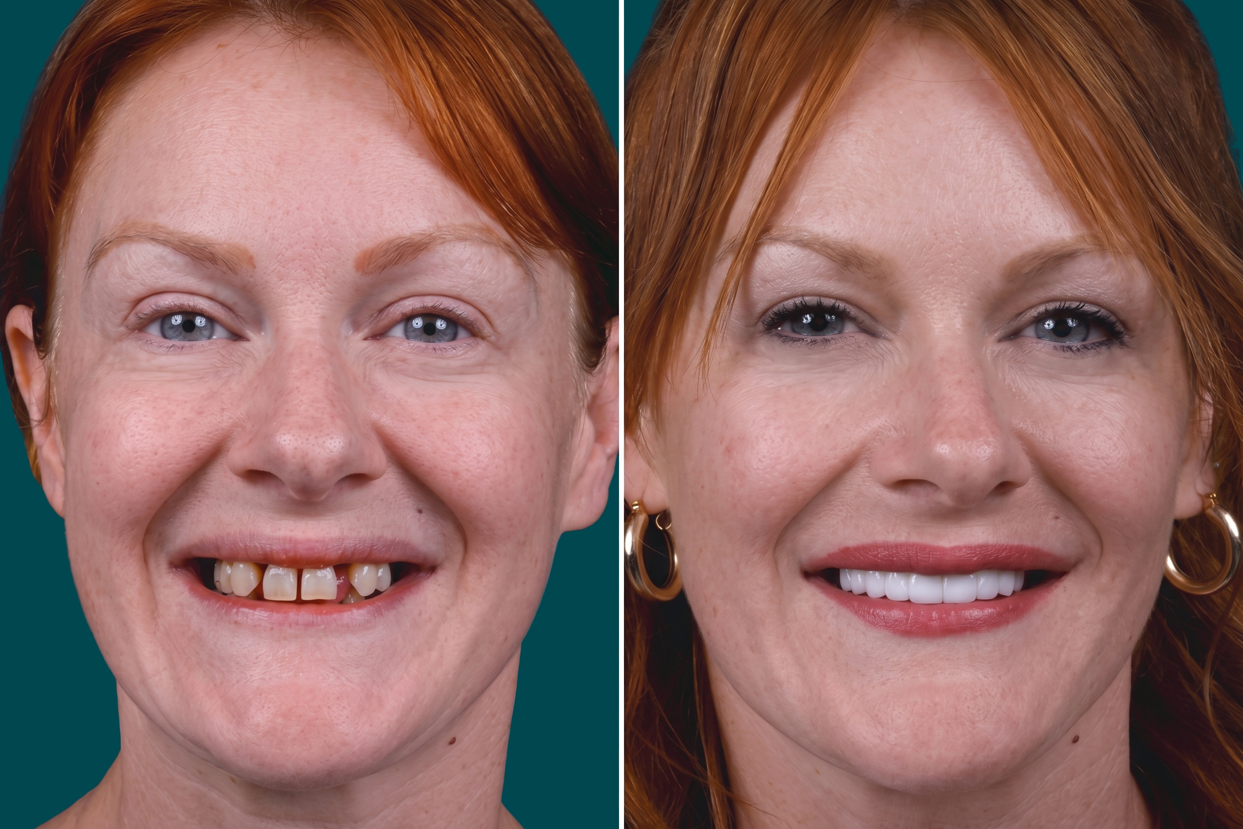 Dental Treatments-Single Dental Implant 