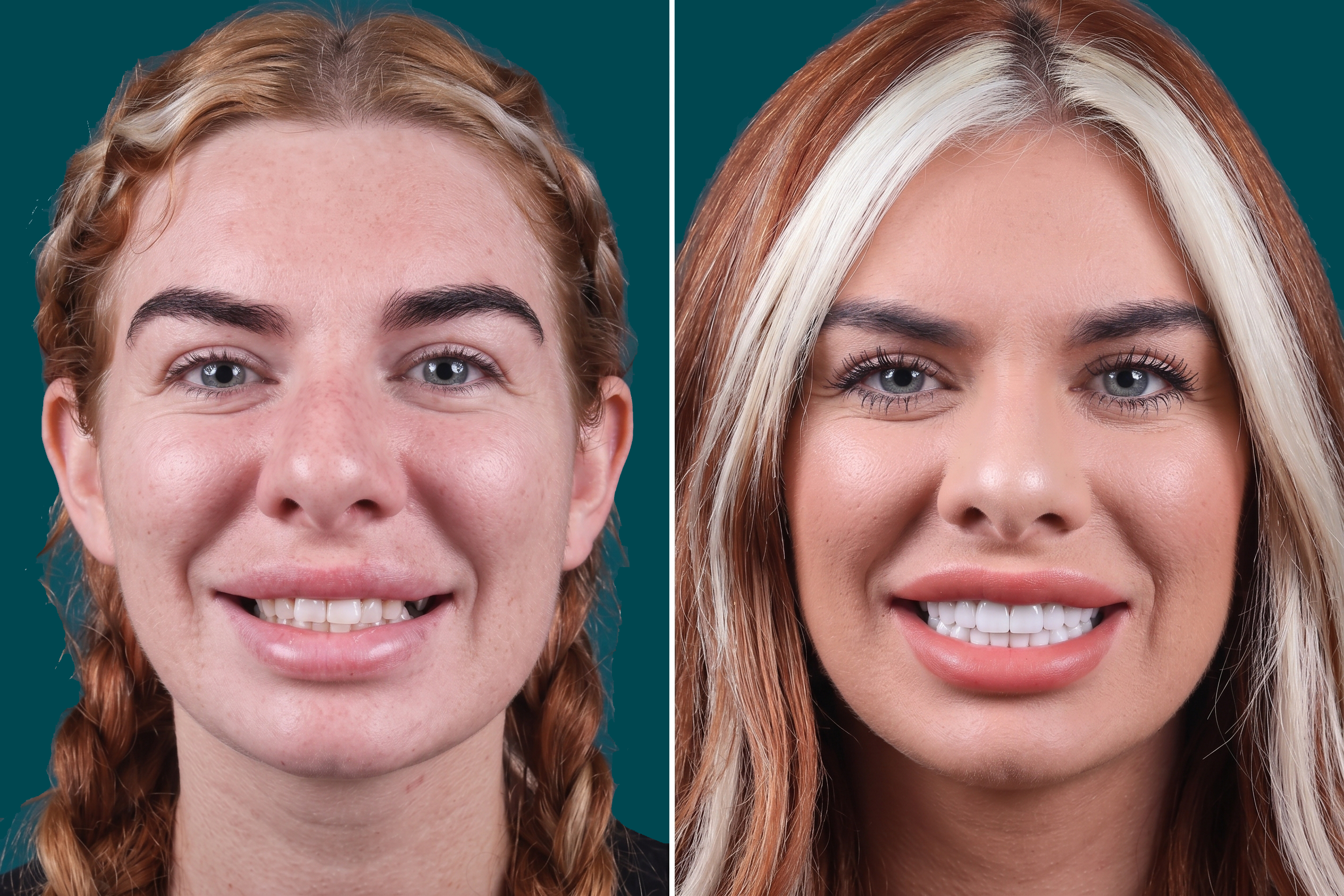 Dental Implants-Single Dental Implant 3