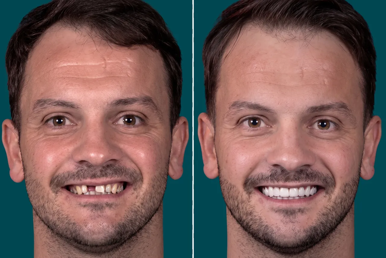 Dental Implants-Single Dental Implant 4