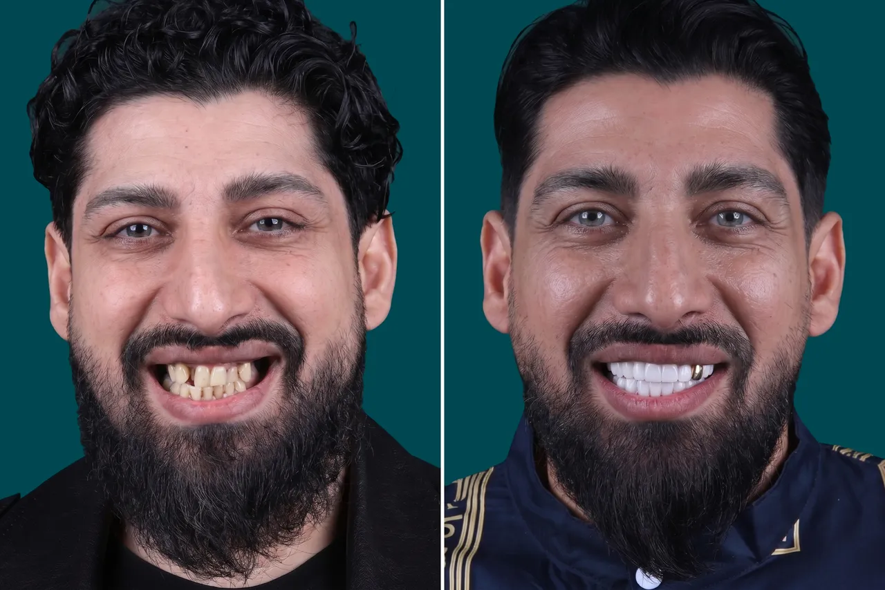 Smile-Makeover 1