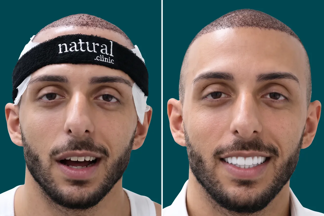 Teeth-Whitening 1