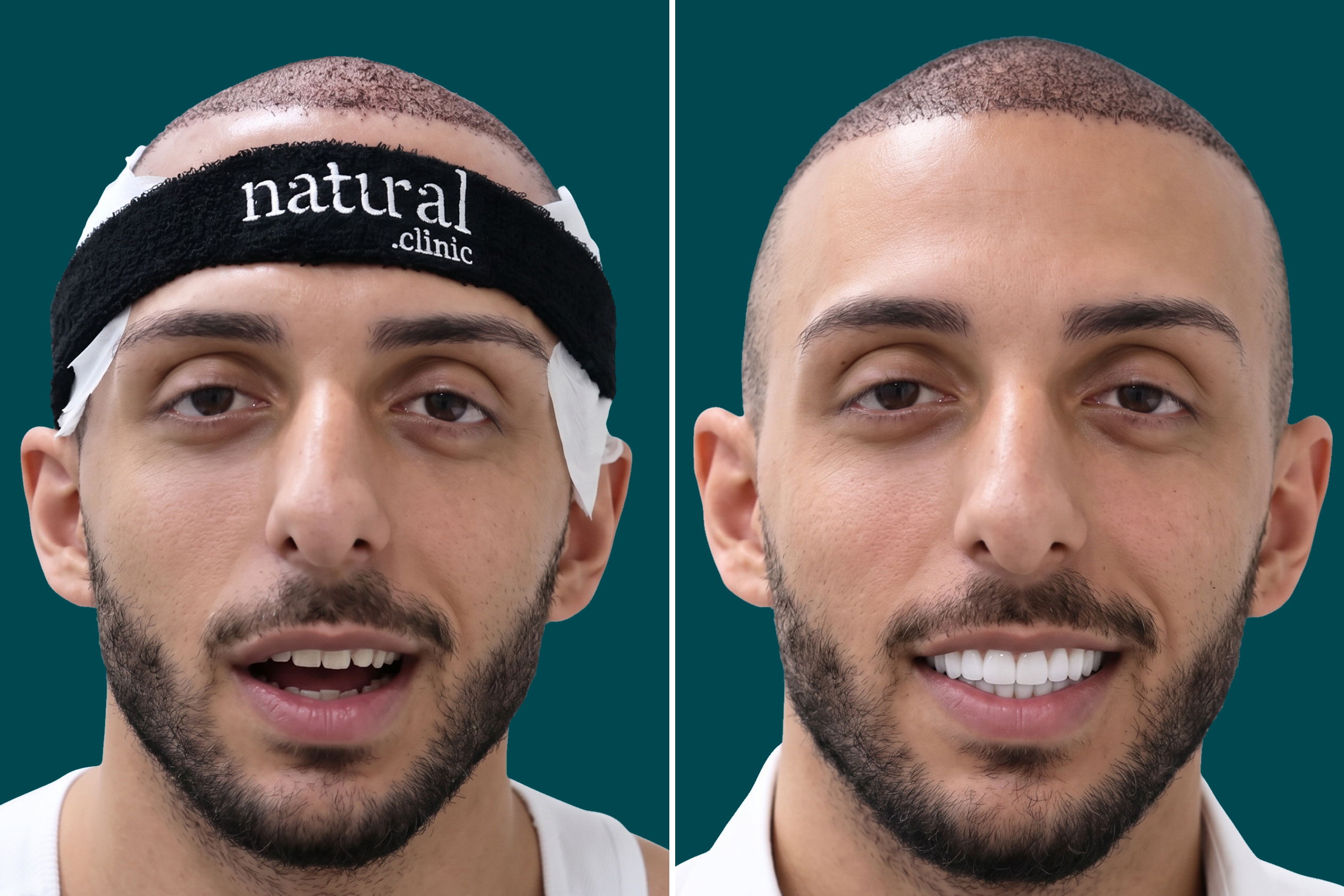 Teeth-Whitening 1