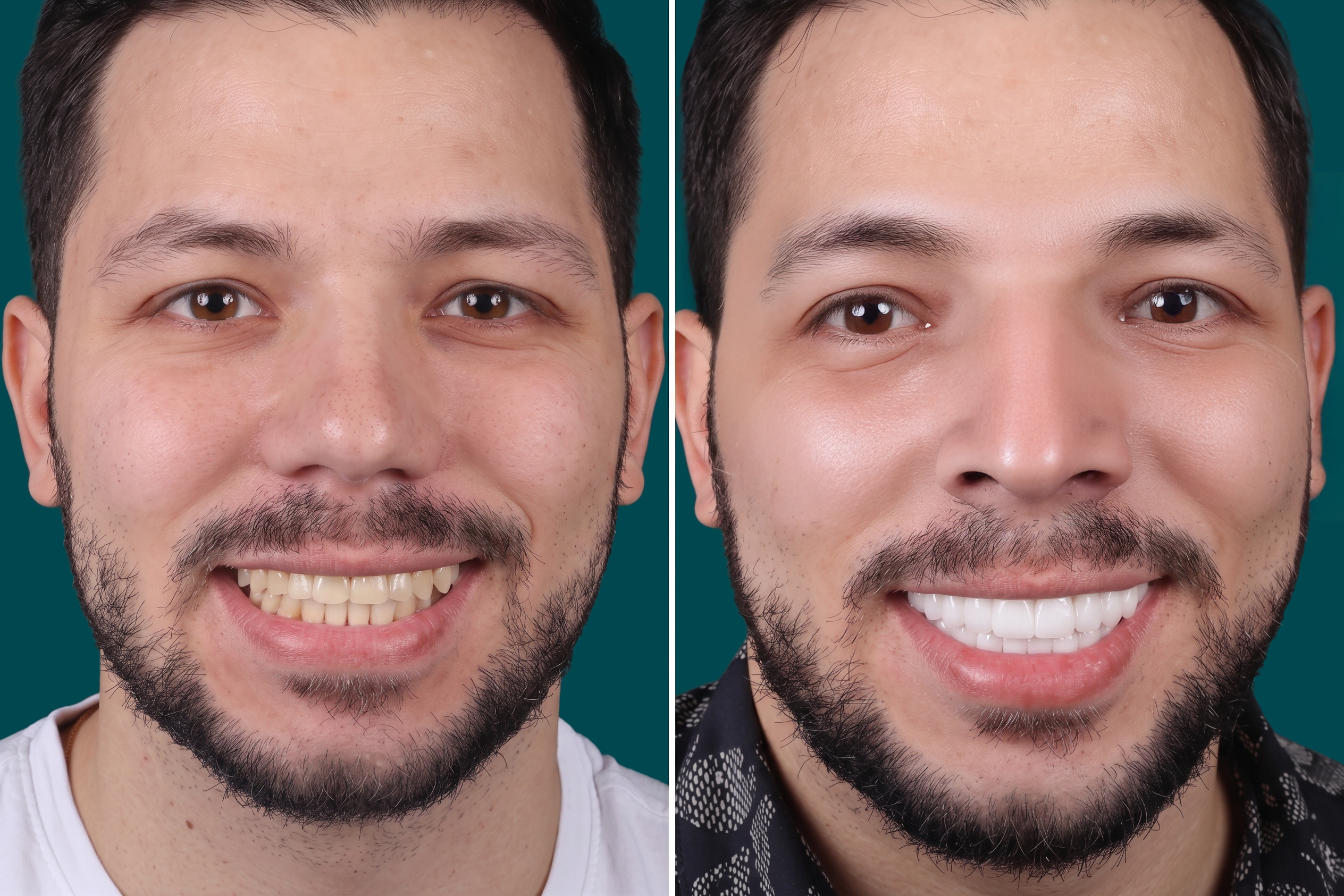 Teeth-Whitening 2