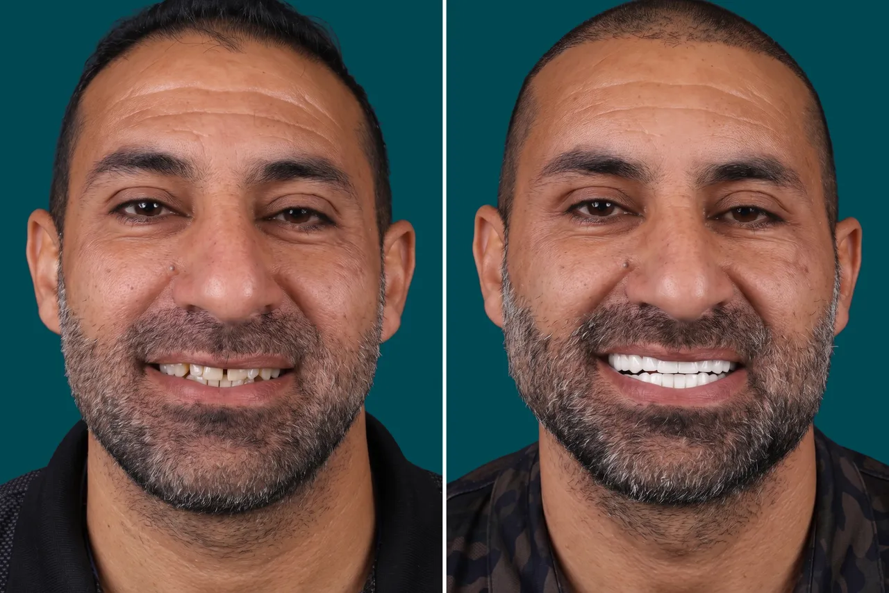 Teeth-Whitening 3