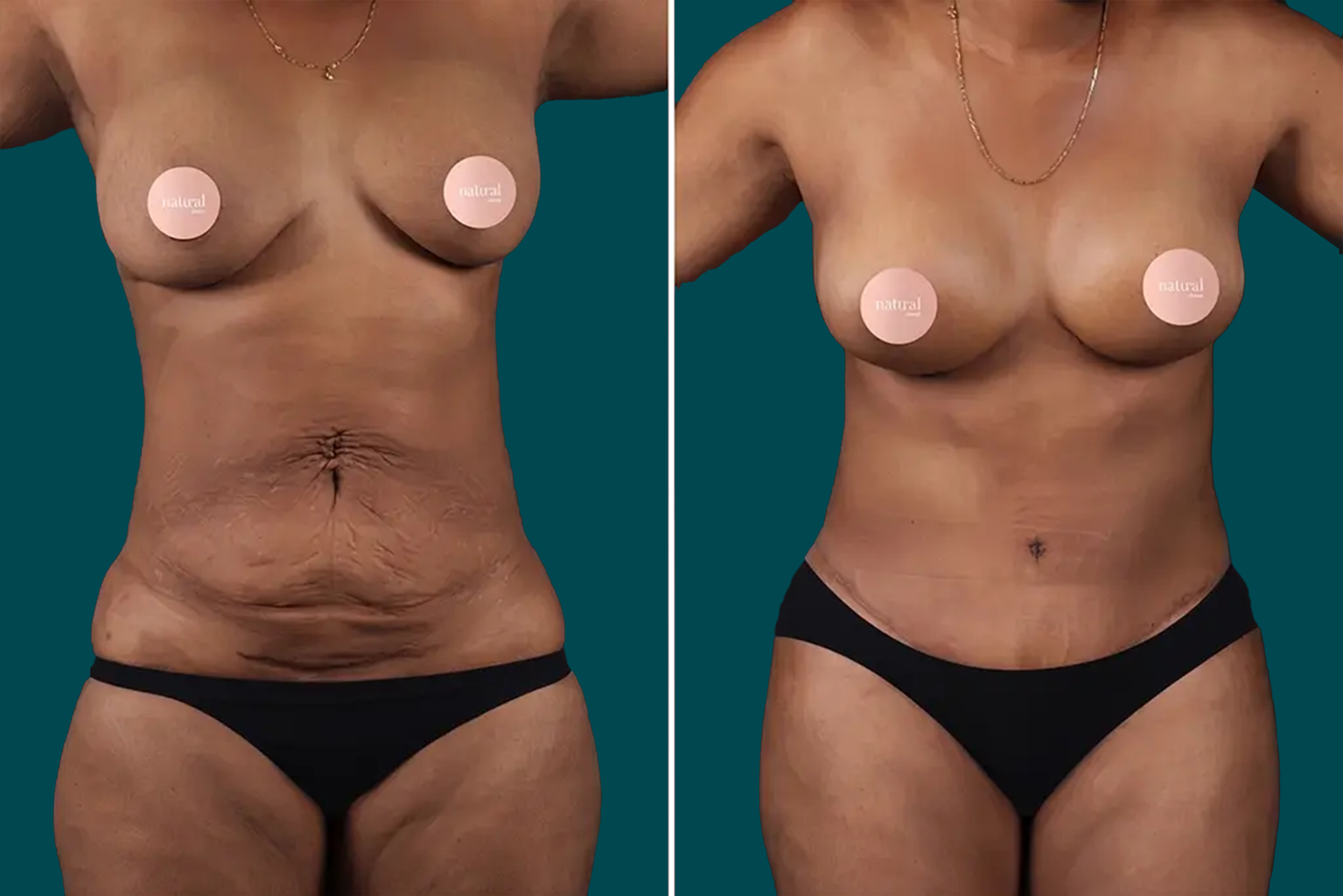 Tummy Tuck Before and After 1