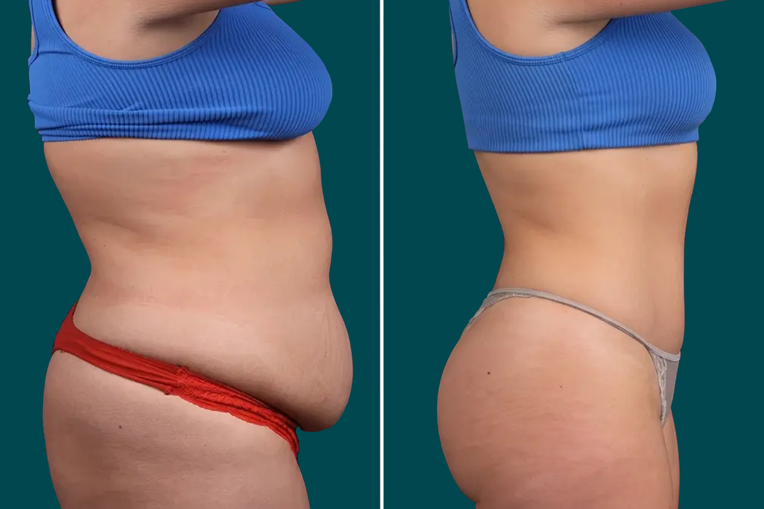 Tummy Tuck Before and After 2