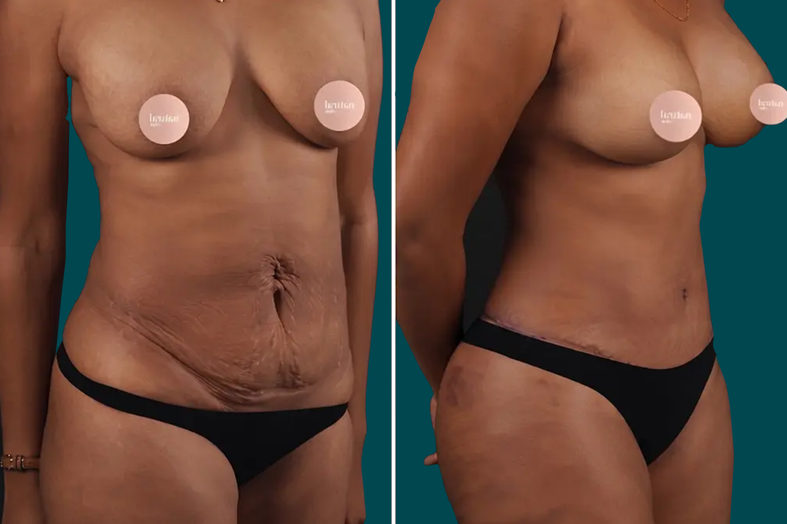 Tummy Tuck Before and After 3