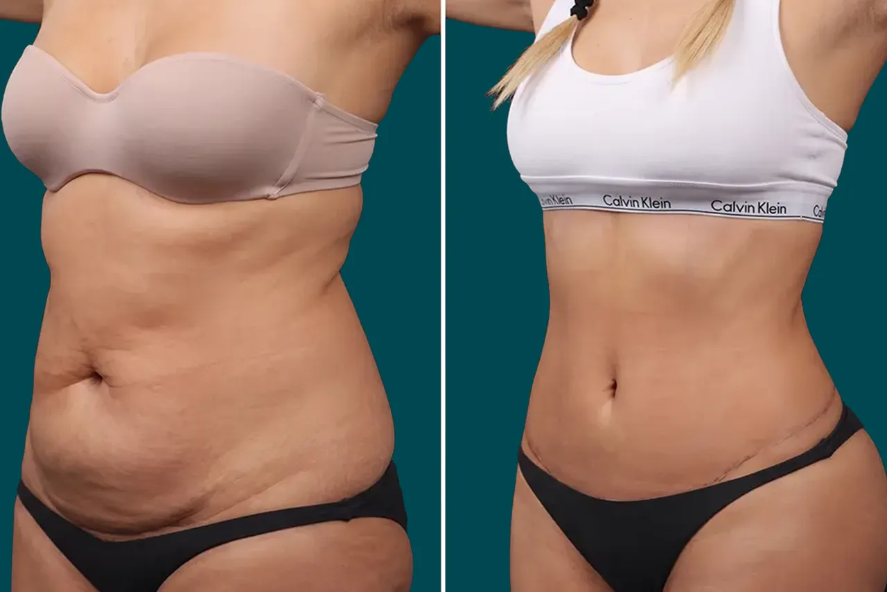 Tummy Tuck Before and After 5