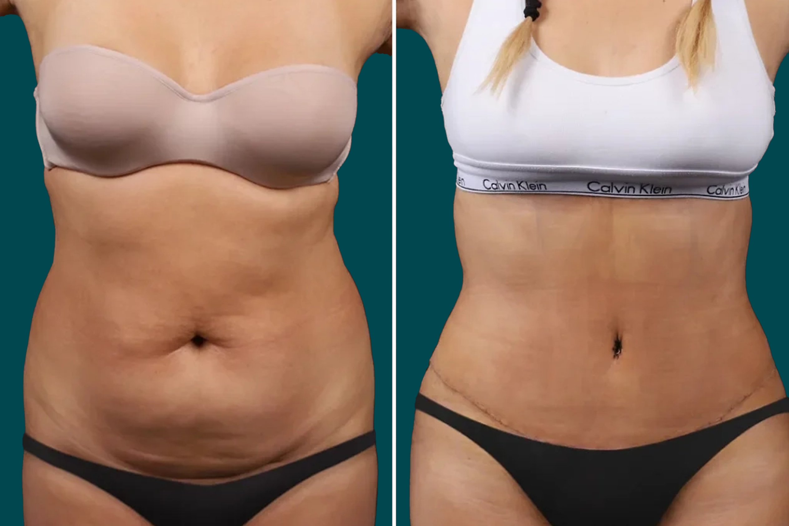 Tummy Tuck Before and After 4