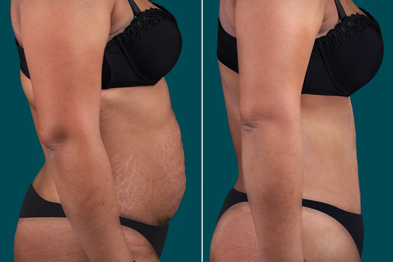 Tummy Tuck Before and After 6