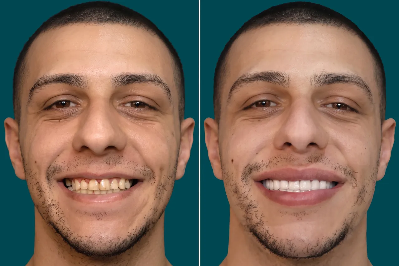Dental-Crowns-Zirconia Crowns 1
