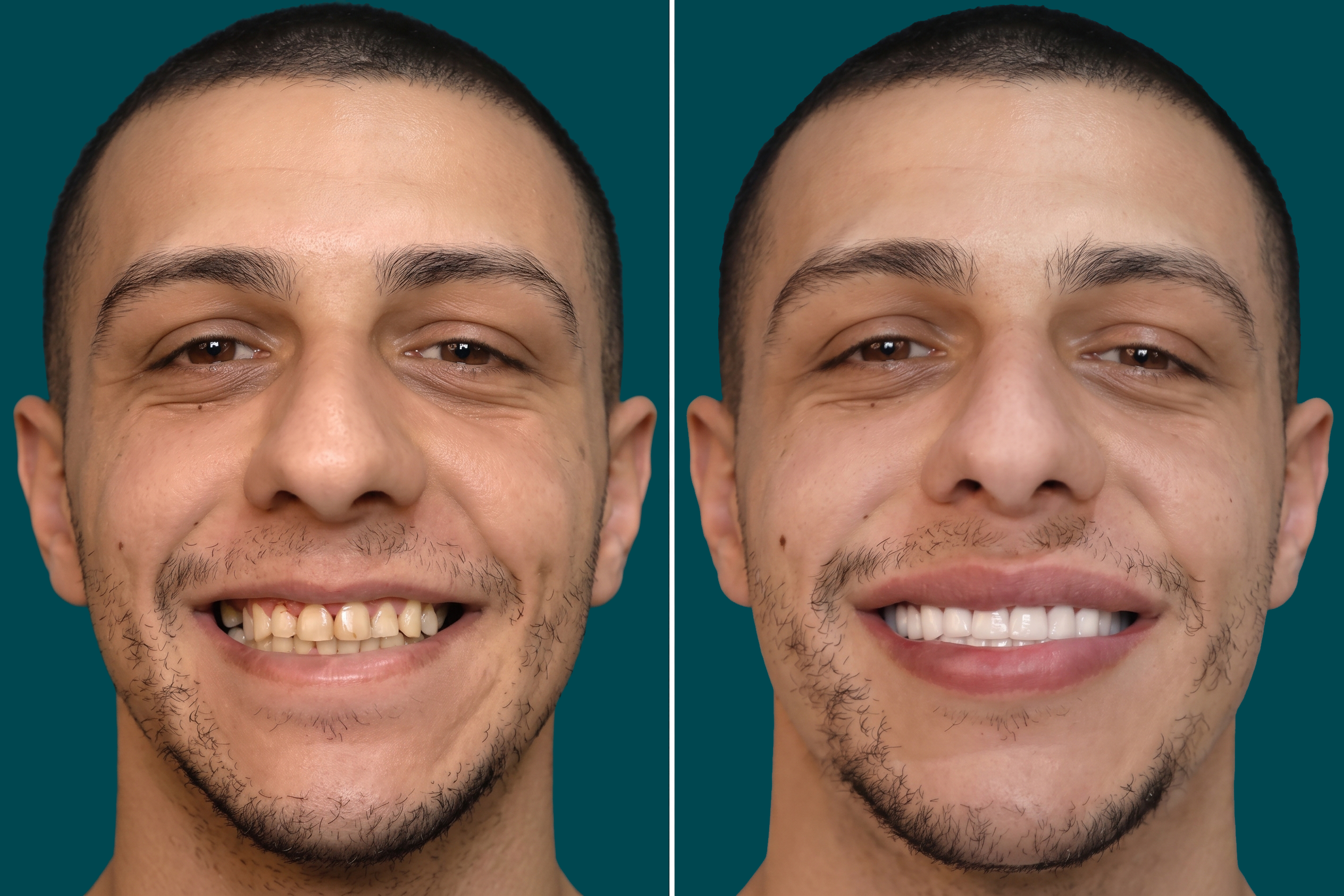 Dental-Crowns-Zirconia Crowns 1
