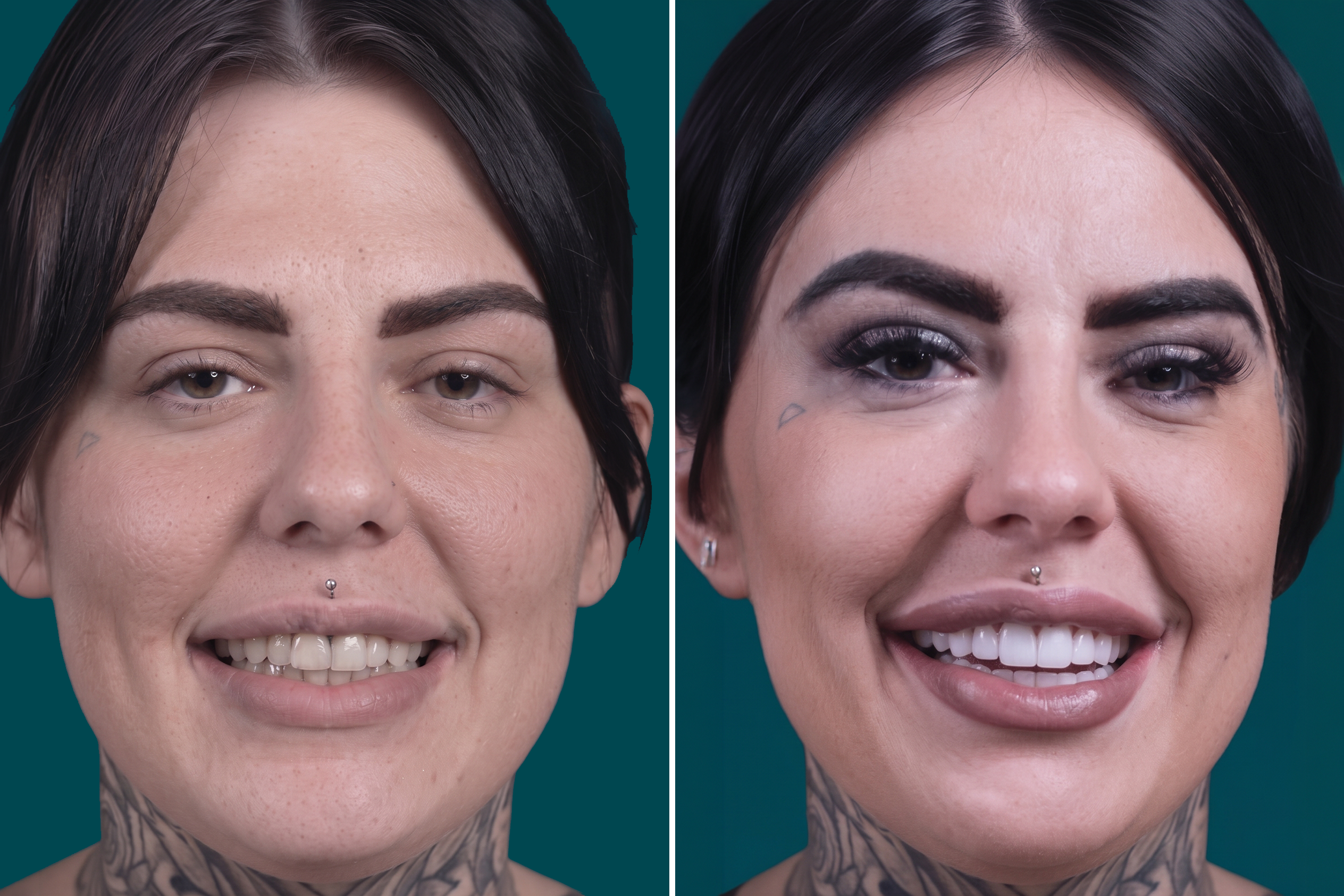 Dental-Veneers-Zirconium Veneers 1