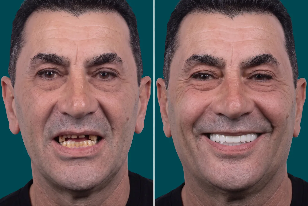 Dental Implants-Zygomatic Implants